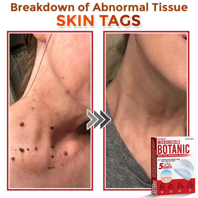 𝗚𝐹O𝙐𝙆® MicroNeedle Botanic Skin Tag Removal Patch ✅Made in USA✅ - FDA Registered Facility