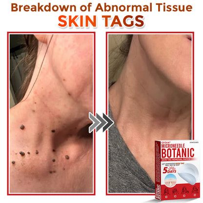 𝗚𝐹O𝙐𝙆® MicroNeedle Botanic Skin Tag Removal Patch ✅Made in USA✅ - FDA Registered Facility