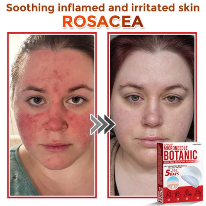 𝗚𝐹O𝙐𝙆® MicroNeedle Botanic Skin Tag Removal Patch ✅Made in USA✅ - FDA Registered Facility