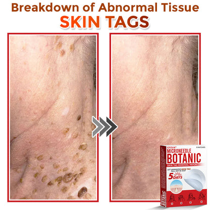 𝗚𝐹O𝙐𝙆® MicroNeedle Botanic Skin Tag Removal Patch ✅Made in USA✅ - FDA Registered Facility