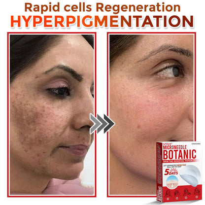 𝗚𝐹O𝙐𝙆® MicroNeedle Botanic Skin Tag Removal Patch ✅Made in USA✅ - FDA Registered Facility