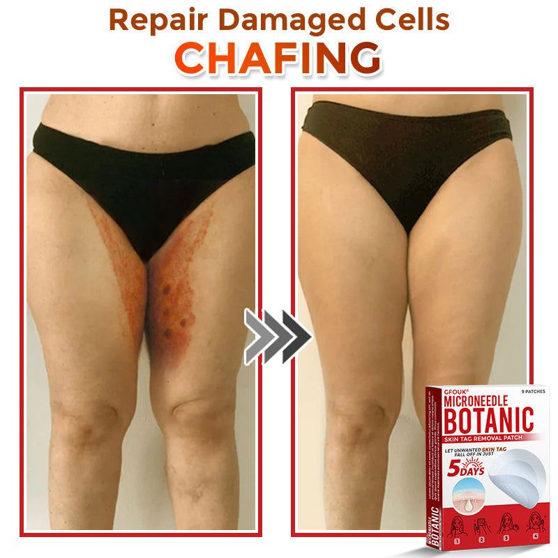 𝗚𝐹O𝙐𝙆® MicroNeedle Botanic Skin Tag Removal Patch ✅Made in USA✅ - FDA Registered Facility