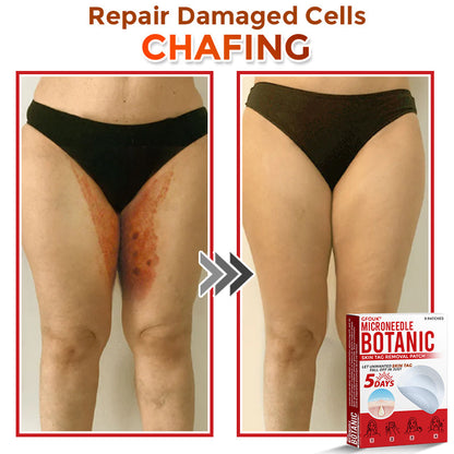 𝗚𝐹O𝙐𝙆® MicroNeedle Botanic Skin Tag Removal Patch ✅Made in USA✅ - FDA Registered Facility