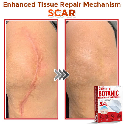 𝗚𝐹O𝙐𝙆® MicroNeedle Botanic Skin Tag Removal Patch ✅Made in USA✅ - FDA Registered Facility