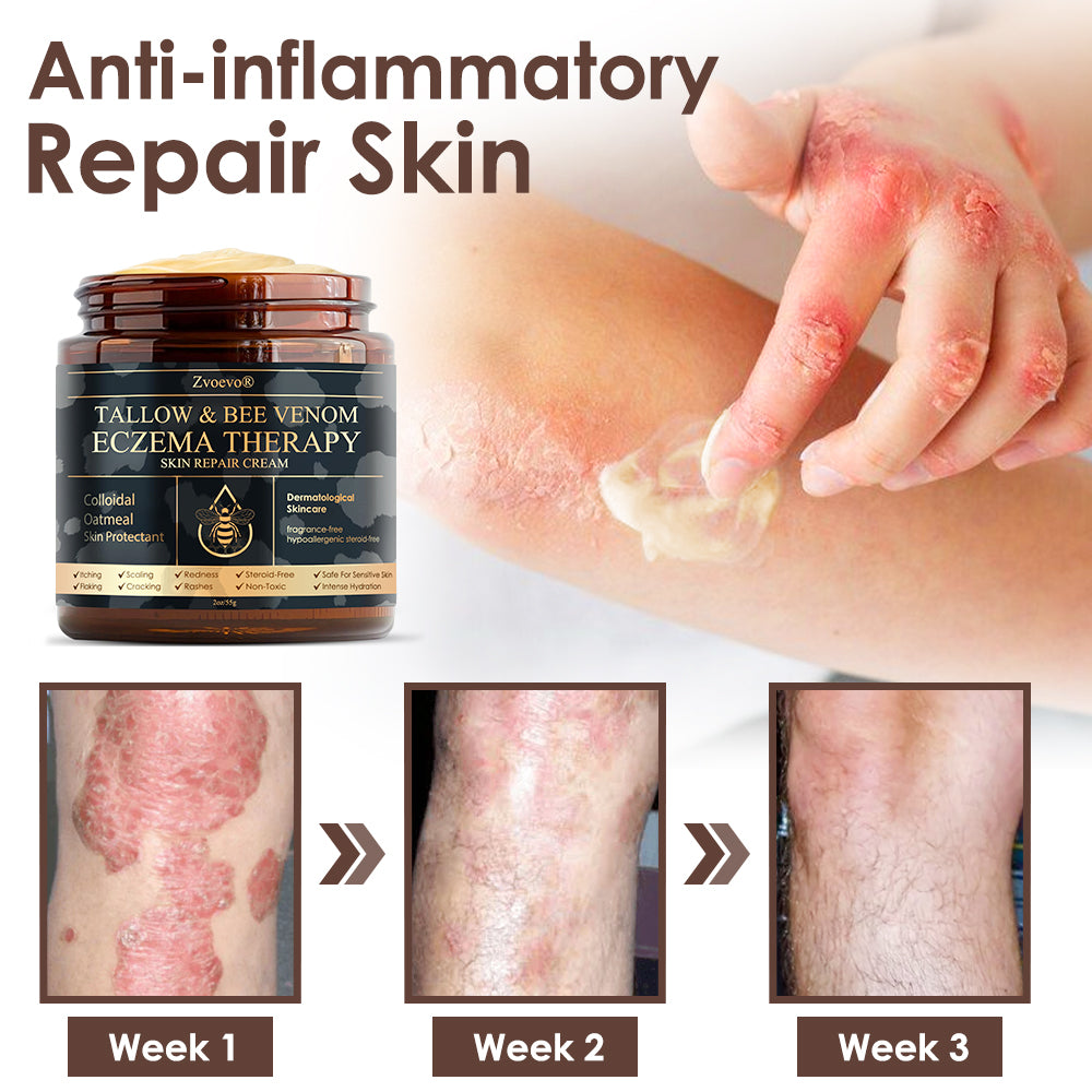 🇺🇸𝗚𝘂𝗮𝗿𝗮𝗻𝘁𝗲𝗲𝗱 𝗻𝗼 𝗿𝗲𝗰𝘂𝗿𝗿𝗲𝗻𝗰𝗲🌿𝐙𝐯𝐨𝐞𝐯𝐨® 𝐓𝐚𝐥𝐥𝐨𝐰 𝐁𝐞𝐞 𝐕𝐞𝐧𝐨𝐦 𝐒𝐤𝐢𝐧 𝐑𝐞𝐬𝐭𝐨𝐫𝐚𝐭𝐢𝐨𝐧 𝐂𝐫𝐞𝐚𝐦🇺🇸𝗠𝗮𝗱𝗲 𝗜𝗻 𝗨𝗦𝗔