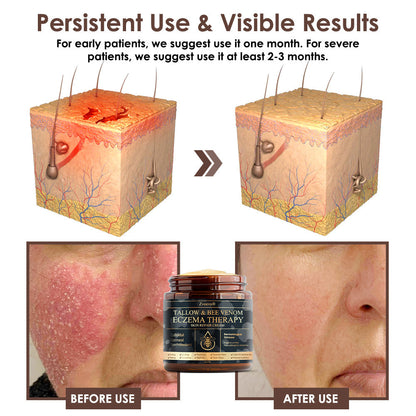 🇺🇸𝗚𝘂𝗮𝗿𝗮𝗻𝘁𝗲𝗲𝗱 𝗻𝗼 𝗿𝗲𝗰𝘂𝗿𝗿𝗲𝗻𝗰𝗲🌿𝐙𝐯𝐨𝐞𝐯𝐨® 𝐓𝐚𝐥𝐥𝐨𝐰 𝐁𝐞𝐞 𝐕𝐞𝐧𝐨𝐦 𝐒𝐤𝐢𝐧 𝐑𝐞𝐬𝐭𝐨𝐫𝐚𝐭𝐢𝐨𝐧 𝐂𝐫𝐞𝐚𝐦🇺🇸𝗠𝗮𝗱𝗲 𝗜𝗻 𝗨𝗦𝗔