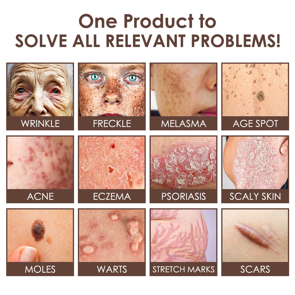 🇺🇸 𝐅𝐃𝐀 𝐎𝐟𝐟𝐢𝐜𝐢𝐚𝐥: 𝐙𝐯𝐨𝐞𝐯𝐨® 𝐓𝐚𝐥𝐥𝐨𝐰 𝐁𝐞𝐞 𝐕𝐞𝐧𝐨𝐦 𝐒𝐤𝐢𝐧 𝐑𝐞𝐬𝐭𝐨𝐫𝐚𝐭𝐢𝐨𝐧 𝐂𝐫𝐞𝐚𝐦 - 𝐀𝐧𝐭𝐢-𝐚𝐠𝐢𝐧𝐠, 𝐇𝐲𝐝𝐫𝐚𝐭𝐢𝐧𝐠, 𝐒𝐤𝐢𝐧 𝐅𝐢𝐫𝐦𝐢𝐧𝐠 & 𝐋𝐢𝐟𝐭𝐢𝐧𝐠, 𝐒𝐤𝐢𝐧 𝐑𝐞𝐩𝐚𝐢𝐫, 𝐄𝐯𝐞𝐧 𝐓𝐨𝐧𝐞, 𝐀𝐜𝐧𝐞 𝐚𝐧𝐝 𝐃𝐚𝐫𝐤 𝐒𝐩𝐨𝐭 𝐓𝐫𝐞𝐚𝐭𝐦𝐞𝐧𝐭, 𝐖𝐚𝐫𝐭 𝐚𝐧𝐝 𝐌𝐨𝐥𝐞 𝐑𝐞𝐦𝐨𝐯𝐚𝐥, 𝐚𝐧𝐝 𝐏𝐬𝐨𝐫𝐢𝐚𝐬𝐢𝐬 𝐑𝐞𝐥𝐢𝐞𝐟.