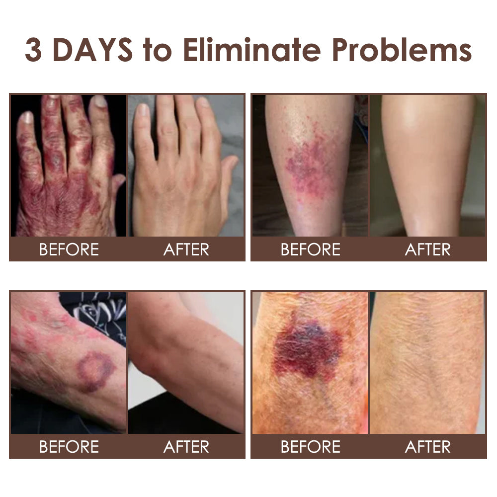 🇺🇸 𝐅𝐃𝐀 𝐎𝐟𝐟𝐢𝐜𝐢𝐚𝐥: 𝐙𝐯𝐨𝐞𝐯𝐨® 𝐓𝐚𝐥𝐥𝐨𝐰 𝐁𝐞𝐞 𝐕𝐞𝐧𝐨𝐦 𝐒𝐤𝐢𝐧 𝐑𝐞𝐬𝐭𝐨𝐫𝐚𝐭𝐢𝐨𝐧 𝐂𝐫𝐞𝐚𝐦 - 𝐀𝐧𝐭𝐢-𝐚𝐠𝐢𝐧𝐠, 𝐇𝐲𝐝𝐫𝐚𝐭𝐢𝐧𝐠, 𝐒𝐤𝐢𝐧 𝐅𝐢𝐫𝐦𝐢𝐧𝐠 & 𝐋𝐢𝐟𝐭𝐢𝐧𝐠, 𝐒𝐤𝐢𝐧 𝐑𝐞𝐩𝐚𝐢𝐫, 𝐄𝐯𝐞𝐧 𝐓𝐨𝐧𝐞, 𝐀𝐜𝐧𝐞 𝐚𝐧𝐝 𝐃𝐚𝐫𝐤 𝐒𝐩𝐨𝐭 𝐓𝐫𝐞𝐚𝐭𝐦𝐞𝐧𝐭, 𝐖𝐚𝐫𝐭 𝐚𝐧𝐝 𝐌𝐨𝐥𝐞 𝐑𝐞𝐦𝐨𝐯𝐚𝐥, 𝐚𝐧𝐝 𝐏𝐬𝐨𝐫𝐢𝐚𝐬𝐢𝐬 𝐑𝐞𝐥𝐢𝐞𝐟.