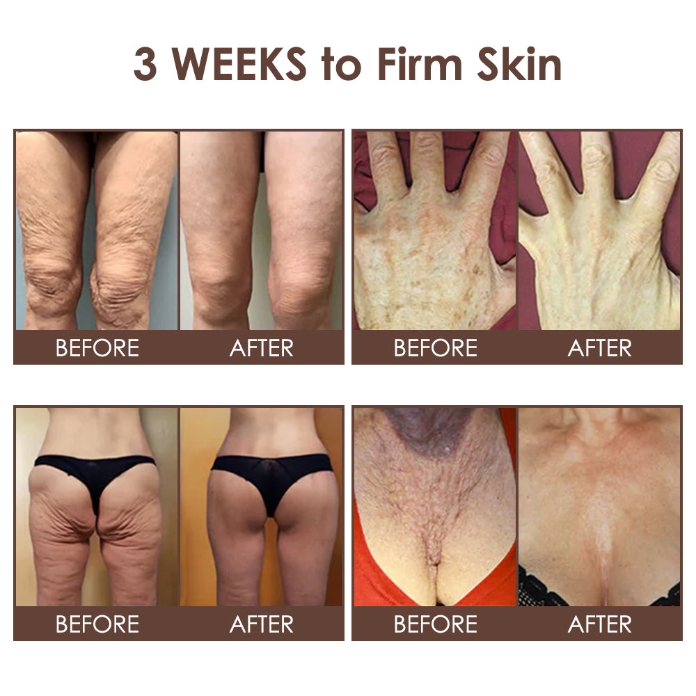 🇺🇸 𝐅𝐃𝐀 𝐎𝐟𝐟𝐢𝐜𝐢𝐚𝐥: 𝐙𝐯𝐨𝐞𝐯𝐨® 𝐓𝐚𝐥𝐥𝐨𝐰 𝐁𝐞𝐞 𝐕𝐞𝐧𝐨𝐦 𝐒𝐤𝐢𝐧 𝐑𝐞𝐬𝐭𝐨𝐫𝐚𝐭𝐢𝐨𝐧 𝐂𝐫𝐞𝐚𝐦 - 𝐀𝐧𝐭𝐢-𝐚𝐠𝐢𝐧𝐠, 𝐇𝐲𝐝𝐫𝐚𝐭𝐢𝐧𝐠, 𝐒𝐤𝐢𝐧 𝐅𝐢𝐫𝐦𝐢𝐧𝐠 & 𝐋𝐢𝐟𝐭𝐢𝐧𝐠, 𝐒𝐤𝐢𝐧 𝐑𝐞𝐩𝐚𝐢𝐫, 𝐄𝐯𝐞𝐧 𝐓𝐨𝐧𝐞, 𝐀𝐜𝐧𝐞 𝐚𝐧𝐝 𝐃𝐚𝐫𝐤 𝐒𝐩𝐨𝐭 𝐓𝐫𝐞𝐚𝐭𝐦𝐞𝐧𝐭, 𝐖𝐚𝐫𝐭 𝐚𝐧𝐝 𝐌𝐨𝐥𝐞 𝐑𝐞𝐦𝐨𝐯𝐚𝐥, 𝐚𝐧𝐝 𝐏𝐬𝐨𝐫𝐢𝐚𝐬𝐢𝐬 𝐑𝐞𝐥𝐢𝐞𝐟.