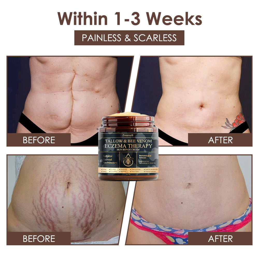 🇺🇸 𝐅𝐃𝐀 𝐎𝐟𝐟𝐢𝐜𝐢𝐚𝐥: 𝐙𝐯𝐨𝐞𝐯𝐨® 𝐓𝐚𝐥𝐥𝐨𝐰 𝐁𝐞𝐞 𝐕𝐞𝐧𝐨𝐦 𝐒𝐤𝐢𝐧 𝐑𝐞𝐬𝐭𝐨𝐫𝐚𝐭𝐢𝐨𝐧 𝐂𝐫𝐞𝐚𝐦 - 𝐀𝐧𝐭𝐢-𝐚𝐠𝐢𝐧𝐠, 𝐇𝐲𝐝𝐫𝐚𝐭𝐢𝐧𝐠, 𝐒𝐤𝐢𝐧 𝐅𝐢𝐫𝐦𝐢𝐧𝐠 & 𝐋𝐢𝐟𝐭𝐢𝐧𝐠, 𝐒𝐤𝐢𝐧 𝐑𝐞𝐩𝐚𝐢𝐫, 𝐄𝐯𝐞𝐧 𝐓𝐨𝐧𝐞, 𝐀𝐜𝐧𝐞 𝐚𝐧𝐝 𝐃𝐚𝐫𝐤 𝐒𝐩𝐨𝐭 𝐓𝐫𝐞𝐚𝐭𝐦𝐞𝐧𝐭, 𝐖𝐚𝐫𝐭 𝐚𝐧𝐝 𝐌𝐨𝐥𝐞 𝐑𝐞𝐦𝐨𝐯𝐚𝐥, 𝐚𝐧𝐝 𝐏𝐬𝐨𝐫𝐢𝐚𝐬𝐢𝐬 𝐑𝐞𝐥𝐢𝐞𝐟.