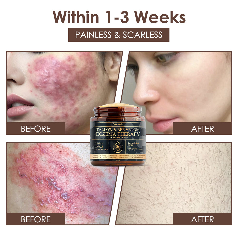 🇺🇸 𝐅𝐃𝐀 𝐎𝐟𝐟𝐢𝐜𝐢𝐚𝐥: 𝐙𝐯𝐨𝐞𝐯𝐨® 𝐓𝐚𝐥𝐥𝐨𝐰 𝐁𝐞𝐞 𝐕𝐞𝐧𝐨𝐦 𝐒𝐤𝐢𝐧 𝐑𝐞𝐬𝐭𝐨𝐫𝐚𝐭𝐢𝐨𝐧 𝐂𝐫𝐞𝐚𝐦 - 𝐀𝐧𝐭𝐢-𝐚𝐠𝐢𝐧𝐠, 𝐇𝐲𝐝𝐫𝐚𝐭𝐢𝐧𝐠, 𝐒𝐤𝐢𝐧 𝐅𝐢𝐫𝐦𝐢𝐧𝐠 & 𝐋𝐢𝐟𝐭𝐢𝐧𝐠, 𝐒𝐤𝐢𝐧 𝐑𝐞𝐩𝐚𝐢𝐫, 𝐄𝐯𝐞𝐧 𝐓𝐨𝐧𝐞, 𝐀𝐜𝐧𝐞 𝐚𝐧𝐝 𝐃𝐚𝐫𝐤 𝐒𝐩𝐨𝐭 𝐓𝐫𝐞𝐚𝐭𝐦𝐞𝐧𝐭, 𝐖𝐚𝐫𝐭 𝐚𝐧𝐝 𝐌𝐨𝐥𝐞 𝐑𝐞𝐦𝐨𝐯𝐚𝐥, 𝐚𝐧𝐝 𝐏𝐬𝐨𝐫𝐢𝐚𝐬𝐢𝐬 𝐑𝐞𝐥𝐢𝐞𝐟.