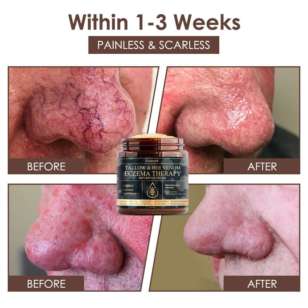 🇺🇸 𝐅𝐃𝐀 𝐎𝐟𝐟𝐢𝐜𝐢𝐚𝐥: 𝐙𝐯𝐨𝐞𝐯𝐨® 𝐓𝐚𝐥𝐥𝐨𝐰 𝐁𝐞𝐞 𝐕𝐞𝐧𝐨𝐦 𝐒𝐤𝐢𝐧 𝐑𝐞𝐬𝐭𝐨𝐫𝐚𝐭𝐢𝐨𝐧 𝐂𝐫𝐞𝐚𝐦 - 𝐀𝐧𝐭𝐢-𝐚𝐠𝐢𝐧𝐠, 𝐇𝐲𝐝𝐫𝐚𝐭𝐢𝐧𝐠, 𝐒𝐤𝐢𝐧 𝐅𝐢𝐫𝐦𝐢𝐧𝐠 & 𝐋𝐢𝐟𝐭𝐢𝐧𝐠, 𝐒𝐤𝐢𝐧 𝐑𝐞𝐩𝐚𝐢𝐫, 𝐄𝐯𝐞𝐧 𝐓𝐨𝐧𝐞, 𝐀𝐜𝐧𝐞 𝐚𝐧𝐝 𝐃𝐚𝐫𝐤 𝐒𝐩𝐨𝐭 𝐓𝐫𝐞𝐚𝐭𝐦𝐞𝐧𝐭, 𝐖𝐚𝐫𝐭 𝐚𝐧𝐝 𝐌𝐨𝐥𝐞 𝐑𝐞𝐦𝐨𝐯𝐚𝐥, 𝐚𝐧𝐝 𝐏𝐬𝐨𝐫𝐢𝐚𝐬𝐢𝐬 𝐑𝐞𝐥𝐢𝐞𝐟.