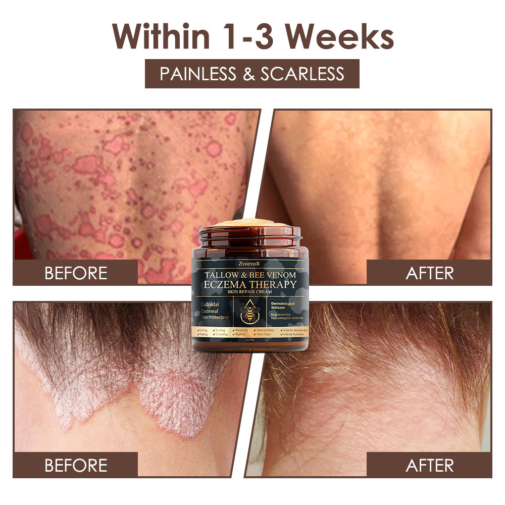 🇺🇸 𝐅𝐃𝐀 𝐎𝐟𝐟𝐢𝐜𝐢𝐚𝐥: 𝐙𝐯𝐨𝐞𝐯𝐨® 𝐓𝐚𝐥𝐥𝐨𝐰 𝐁𝐞𝐞 𝐕𝐞𝐧𝐨𝐦 𝐒𝐤𝐢𝐧 𝐑𝐞𝐬𝐭𝐨𝐫𝐚𝐭𝐢𝐨𝐧 𝐂𝐫𝐞𝐚𝐦 - 𝐀𝐧𝐭𝐢-𝐚𝐠𝐢𝐧𝐠, 𝐇𝐲𝐝𝐫𝐚𝐭𝐢𝐧𝐠, 𝐒𝐤𝐢𝐧 𝐅𝐢𝐫𝐦𝐢𝐧𝐠 & 𝐋𝐢𝐟𝐭𝐢𝐧𝐠, 𝐒𝐤𝐢𝐧 𝐑𝐞𝐩𝐚𝐢𝐫, 𝐄𝐯𝐞𝐧 𝐓𝐨𝐧𝐞, 𝐀𝐜𝐧𝐞 𝐚𝐧𝐝 𝐃𝐚𝐫𝐤 𝐒𝐩𝐨𝐭 𝐓𝐫𝐞𝐚𝐭𝐦𝐞𝐧𝐭, 𝐖𝐚𝐫𝐭 𝐚𝐧𝐝 𝐌𝐨𝐥𝐞 𝐑𝐞𝐦𝐨𝐯𝐚𝐥, 𝐚𝐧𝐝 𝐏𝐬𝐨𝐫𝐢𝐚𝐬𝐢𝐬 𝐑𝐞𝐥𝐢𝐞𝐟.