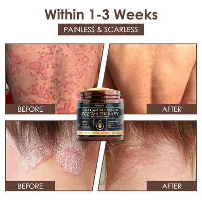 🇺🇸 𝐅𝐃𝐀 𝐎𝐟𝐟𝐢𝐜𝐢𝐚𝐥: 𝐙𝐯𝐨𝐞𝐯𝐨® 𝐓𝐚𝐥𝐥𝐨𝐰 𝐁𝐞𝐞 𝐕𝐞𝐧𝐨𝐦 𝐒𝐤𝐢𝐧 𝐑𝐞𝐬𝐭𝐨𝐫𝐚𝐭𝐢𝐨𝐧 𝐂𝐫𝐞𝐚𝐦 - 𝐀𝐧𝐭𝐢-𝐚𝐠𝐢𝐧𝐠, 𝐇𝐲𝐝𝐫𝐚𝐭𝐢𝐧𝐠, 𝐒𝐤𝐢𝐧 𝐅𝐢𝐫𝐦𝐢𝐧𝐠 & 𝐋𝐢𝐟𝐭𝐢𝐧𝐠, 𝐒𝐤𝐢𝐧 𝐑𝐞𝐩𝐚𝐢𝐫, 𝐄𝐯𝐞𝐧 𝐓𝐨𝐧𝐞, 𝐀𝐜𝐧𝐞 𝐚𝐧𝐝 𝐃𝐚𝐫𝐤 𝐒𝐩𝐨𝐭 𝐓𝐫𝐞𝐚𝐭𝐦𝐞𝐧𝐭, 𝐖𝐚𝐫𝐭 𝐚𝐧𝐝 𝐌𝐨𝐥𝐞 𝐑𝐞𝐦𝐨𝐯𝐚𝐥, 𝐚𝐧𝐝 𝐏𝐬𝐨𝐫𝐢𝐚𝐬𝐢𝐬 𝐑𝐞𝐥𝐢𝐞𝐟.